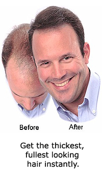 HAIR LOSS